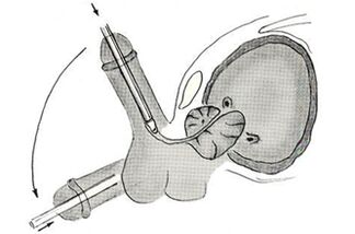 Scheme of endoscopic penile enlargement surgery