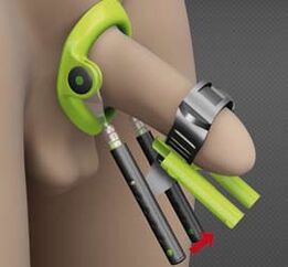 Rehabilitation after surgery to increase penis