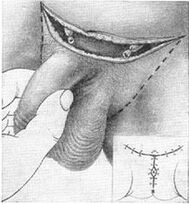 Surgical lengthening of the penis by exposing its hidden part